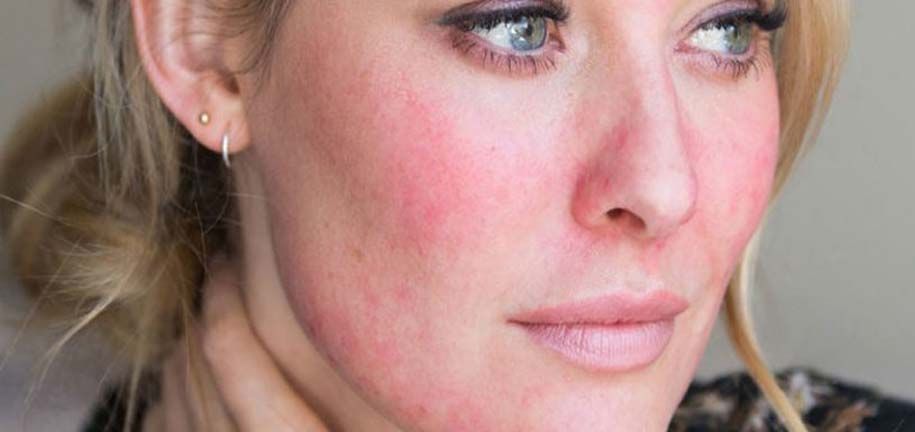 Pflege für trockene und gereizte Haut