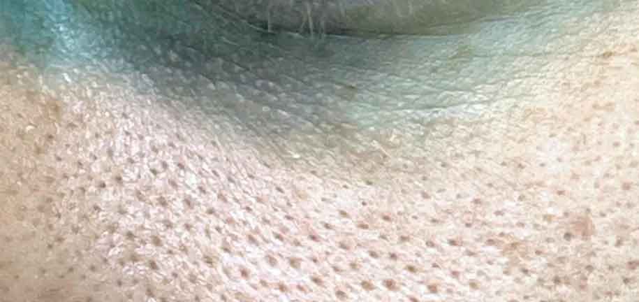 Vergrößerte Poren im Gesicht