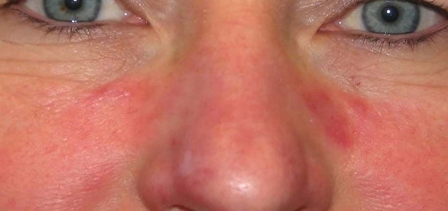 Seborrhoische Hautpflege