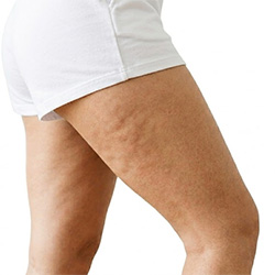 Cellulite Hautpflegeprodukte für die Körperpflege