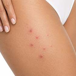 Professionelle Pflege gegen eingewachsene Haare für glatter aussehende Haut