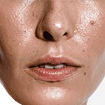 Hautpflege für fettige Haut