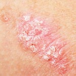 Psoriasis Cremes und Behandlungen für trockene, schuppige Haut