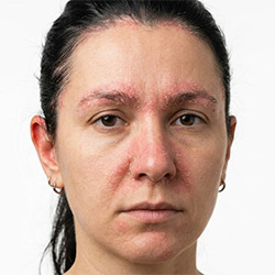 Seborrhoe Hautpflege für Gesicht und Kopfhaut