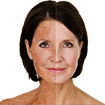 Sonnengeschädigte Haut